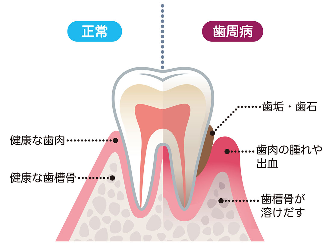 正常な歯・歯周病の歯
